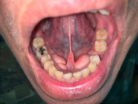 Common Symptoms Of Gingival Hyperplasia Rockville All Smiles Dentistry