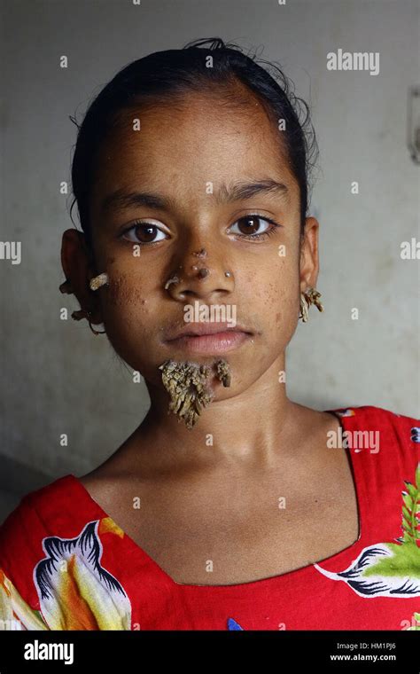 Dhaka Bangladesh F Vr Patient Du Bangladesh Sahana Khatun Pose Pour Une Photo