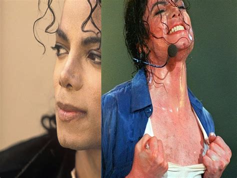 Michael Jackson Vitiligo Before And After
