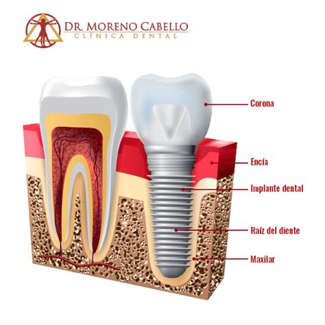 Materiales De Alta Biocompatibilidad Clínica Dental Córdoba