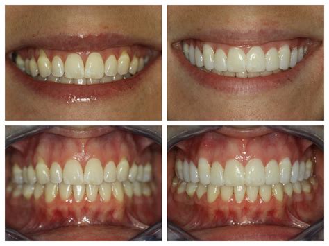 Porcelain Veneer Before And After ~ Trial Smile Sugar Fix Dental