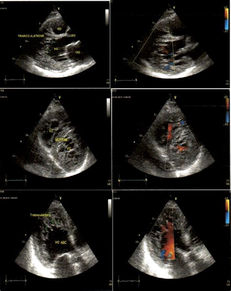 2d Echocardiogram Of The Left Ventricle Upper Panel Shows The