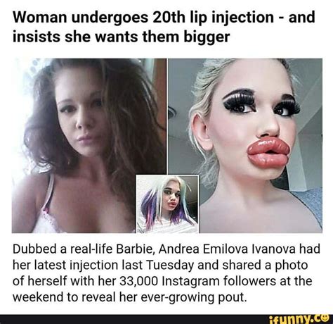 Woman Undergoes 20th Lip Injection And Insists She Wants Them Bigger Dubbed A Real Life Barbie