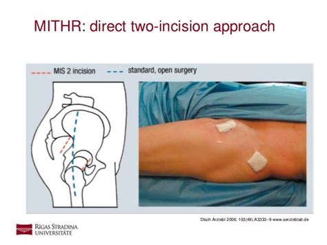 Minimally Invasive Total Hip Replacement