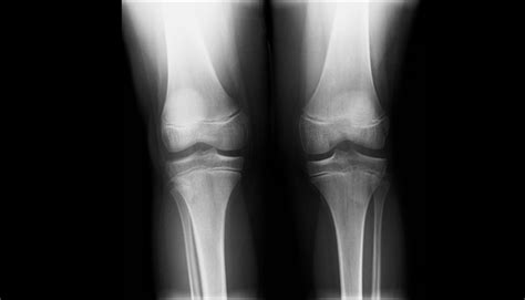 Ortho Dx Popping And Pain In An Adolescents Knee Clinical Advisor