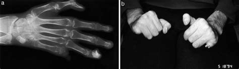 A And B Autoamputation Of Bilateral Small Finger Distal Phalanges And