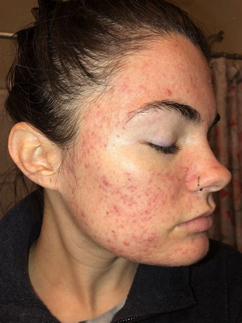 Super Red Scars With Acne Pics Hyperpigmentation Reddark Marks