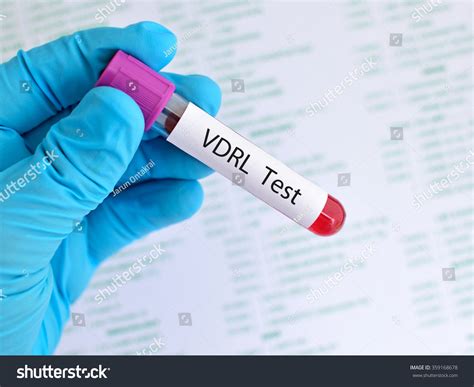 The disease is typically diagnosed with blood tests that detect proteins, called. Blood Sample Vdrl Test Syphilis Disease Stock Photo ...