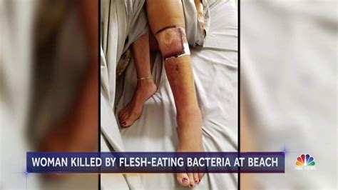 Flesh Eating Bacteria In Florida Waters Three Things You Need To Know