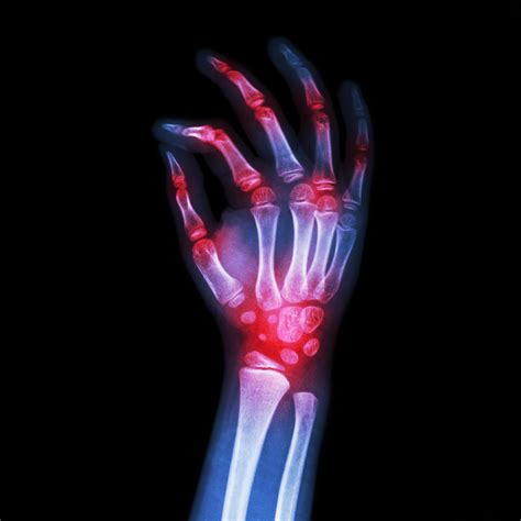 get quote call now get directions. High uric acid levels cause Gout, which... - Klinik ...