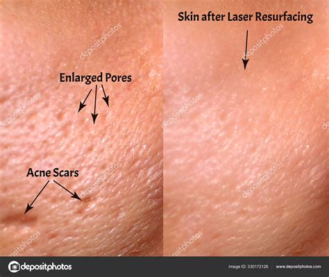 Large Pores Before And After