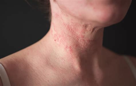 Experiencing Eczema Swinyer Woseth Dermatology