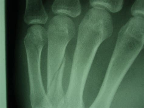 Broken Fractured Fingers Doctor Singapore Sports And Orthopaedic Surgeon