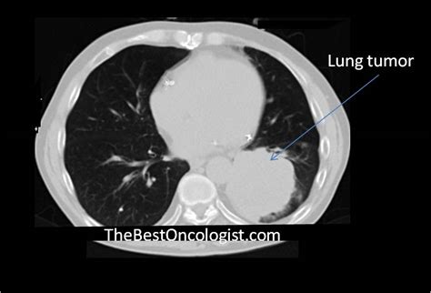 Pics Of Lung Cancer On Ct Scan Lung Cancer The Bmj Dana Raymond