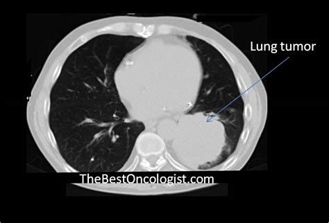 Tumors that originate in the lung (primary lung tumors) are very rare in cats. Can Lung Cancer Be Diagnosed With A Ct Scan - ct scan machine