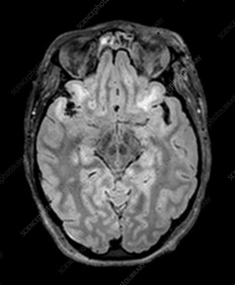 Severe Traumatic Brain Injury Mri Stock Image C0271723 Science