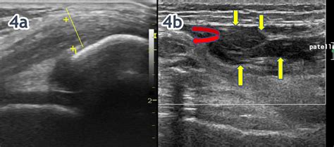 The Use Of Msk Ultrasound With Quadriceps Muscle Injury Published In