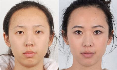 asian blepharoplasty double eyelid surgery before and after photo gallery page 2 of 3 dr