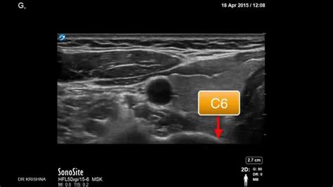 Stellate Ganglion Block Under Ultrasound By Dr Murli Krishna Youtube
