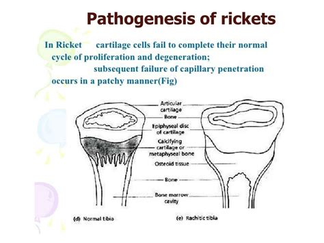 Ppt Rickets In Children Powerpoint Presentation Free Download Id