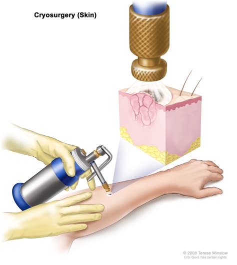 Cryoablation Patient Siteman Cancer Center