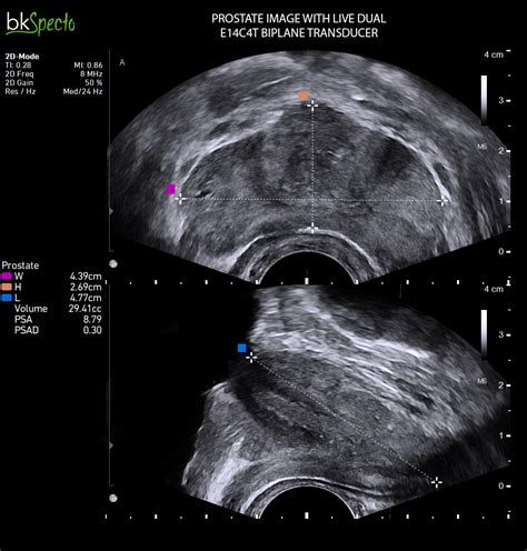 Bkspecto Ultrasound Machine Bk Medical