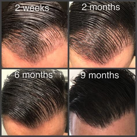 Orange county california hair transplant surgeon dr. Hair Transplant Timeline | Hair Transplant Los Angeles ...