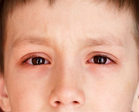 Red Eye Symptoms And Treatment