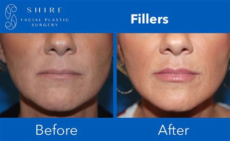 Fillers Before And After Shire Facial Plastic Surgery