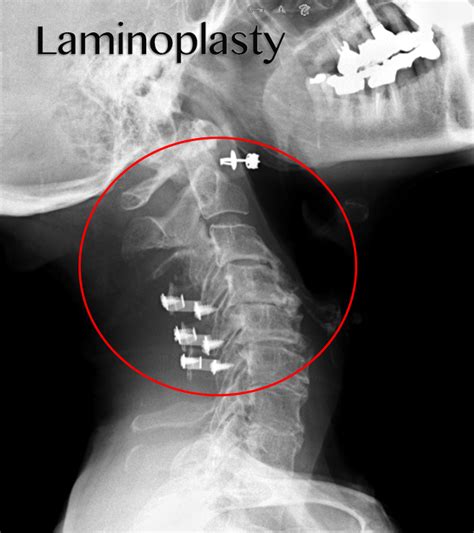 Cervical Laminoplasty Manhattan Spine Consultants