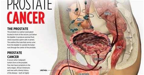 Decreased force in the stream of urine. The Truth About Prostate Cancer: The Truth About Prostate ...
