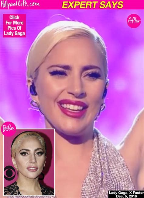 Lady Gaga Did She Have Work Done On Her Face Plastic Surgeon Speaks Lady Gaga Nose Job