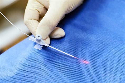 Endovenous Laser Ablation Varicose Vein Removal Treatment Vein