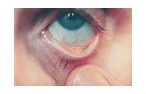 Iron Deficiency Anemia Eyes