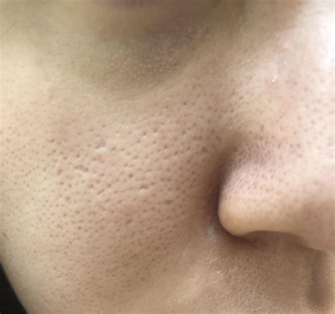 Please Help Very Enlarged Poresmini Craters On Cheek Nose And