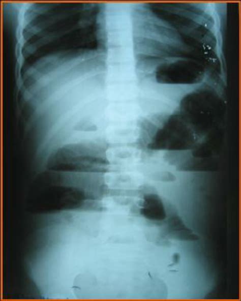 X Ray Of The Abdomen Showed Multiple Air Fluid Levels Without Any Gas