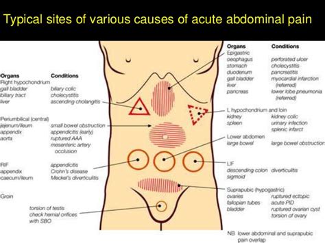 Gynecological Causes Of Acute Abdominal Pain