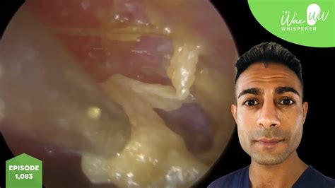 1083 Complex Eardrum Perforation Ear Wax Removal Youtube