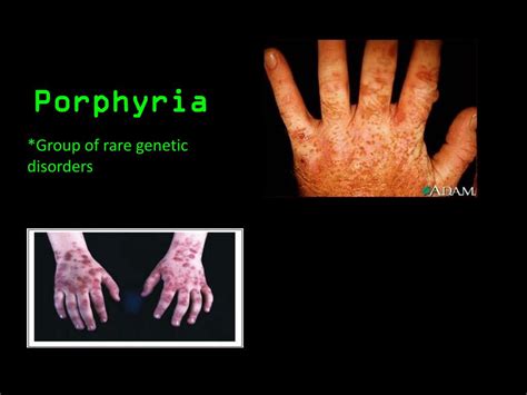 Ppt Porphyria Powerpoint Presentation Free Download Id2122328