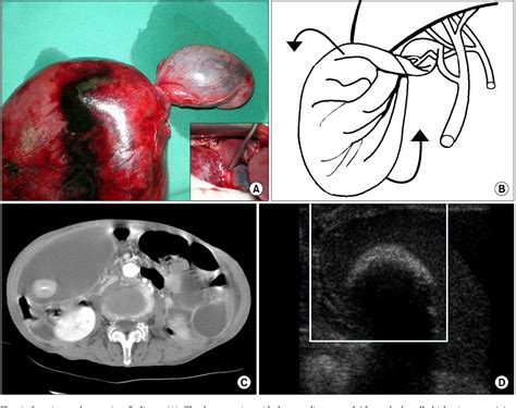 Figure 1 From A Literature Review Of The Gallbladder Torsion Along The