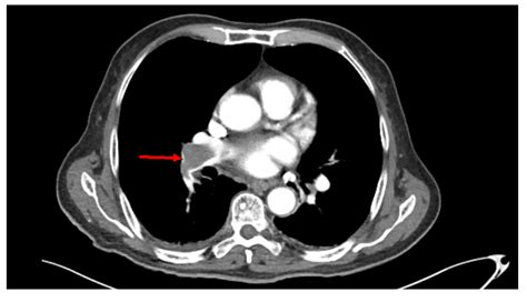Cureus Incidental Finding Of Saddle Pulmonary Embolism On A Ct Scan
