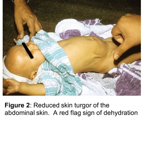 Severe Dehydration In Children