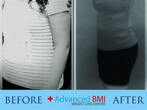 Weight Loss Surgery Before And After Advanced Bmi Lebanon Dr Nagi