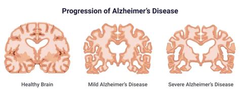 Alzheimers Disease Causes Stages Symptoms And Prevention