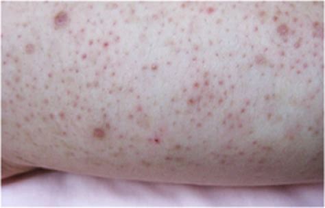 What Are Crusty Patches On Skin How To Treat Scaly Spots On Skin