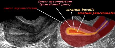 Myometrium Ultrasound Of The Uterus Showing Normal Endometrium And