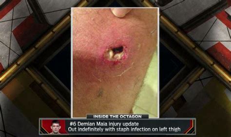 An ingrown hair may be affected by the staphylococcus or staph infection strain. Petition to ban Staph from MMA! | Page 3 | MMAjunkie.com ...