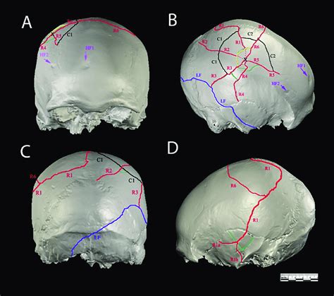 Perimortem fractures LF (in blue) and DF (in red yellow ...