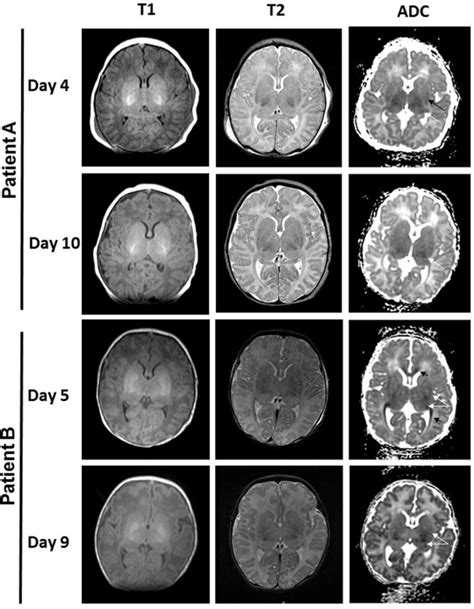 Early Versus Late Brain Magnetic Resonance Imaging After Neonatal