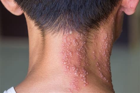 What Is The Difference Between Shingles And Herpes Simplex Run Down